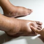 How-Proper-Leg-Elevation-Works-to-Improve-Edema-150x150